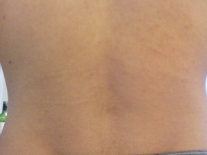 Cicatrices visibles dans le dos de Jeff à gauche de la photo